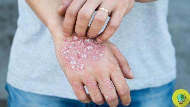 Eczema: 10 remedios naturales