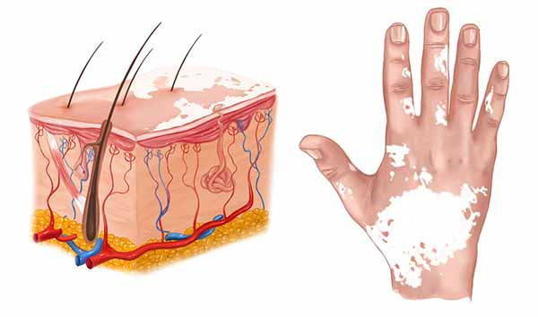 Vitiligo: causes, types and treatment of white patches