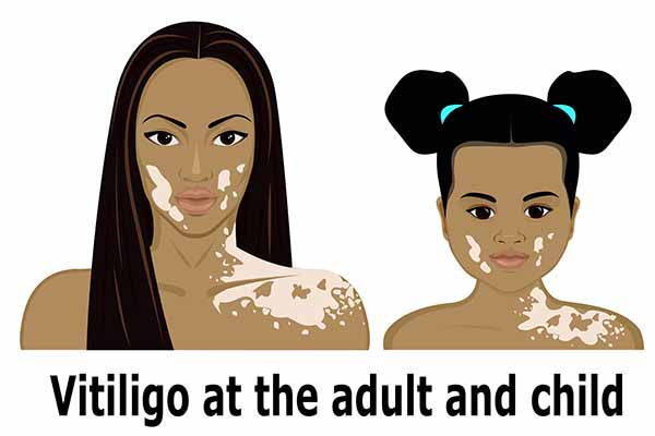 Vitiligo : causes, types et traitement des plaques blanches