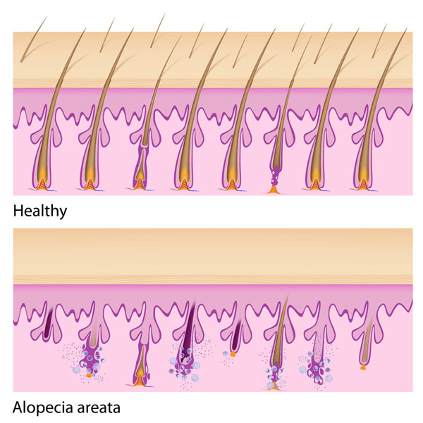 Alopécie : causes, symptômes et comment la reconnaître