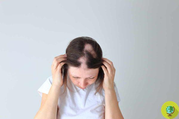 Alopecia: causes, symptoms and how to recognize it