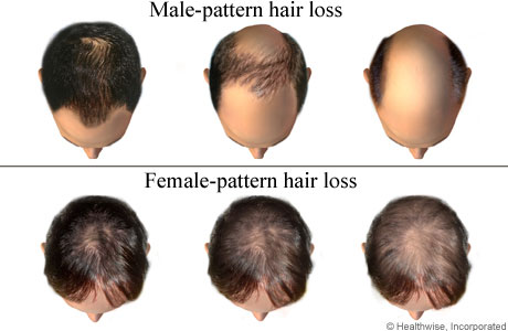 Alopecia: causes, symptoms and how to recognize it