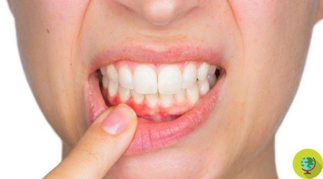 Gingivitis: symptoms, causes and treatments